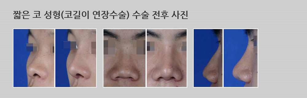 짧은 코 성형(코길이 연장수술) 수술 전후 사진