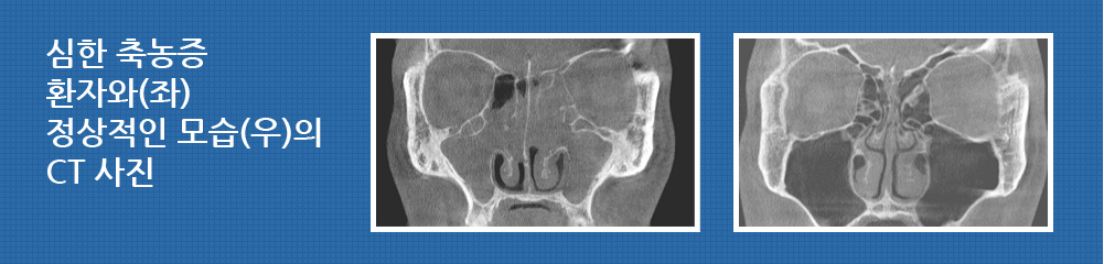 심한 축농증 환자와(좌) 정상적인 모습(우)의 CT 사진